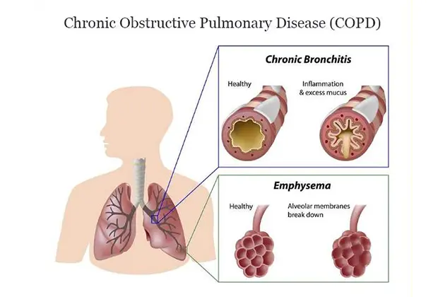 An Overview of COPD Key Causes, Symptoms, and Challenges