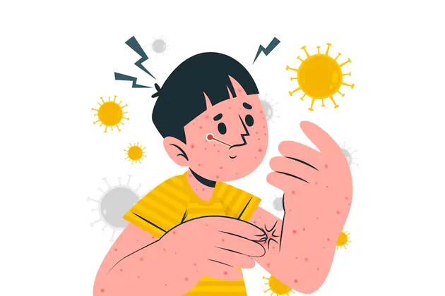 Measles outbreak in US