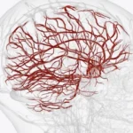 What are Brain Aneurysms and Their Disability Benefits