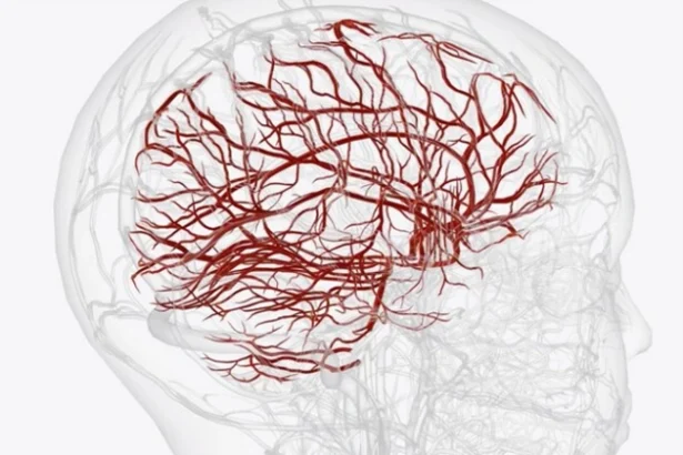 What are Brain Aneurysms and Their Disability Benefits