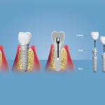 How to Care for Your Molar Dental Implants for Long Lasting Results