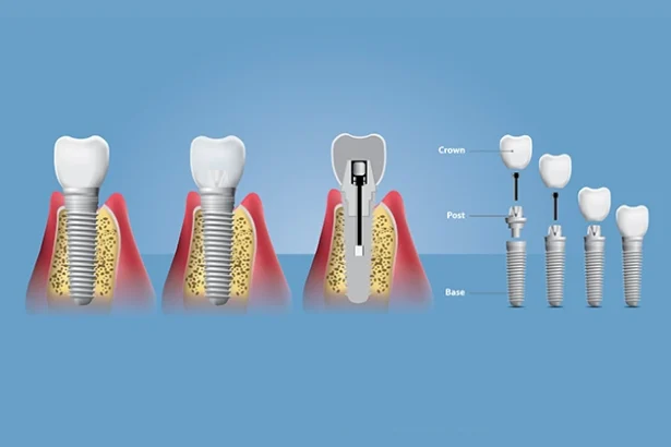How to Care for Your Molar Dental Implants for Long Lasting Results