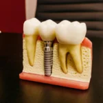 What to Expect During a Single Tooth Implant Procedure in Long Beach
