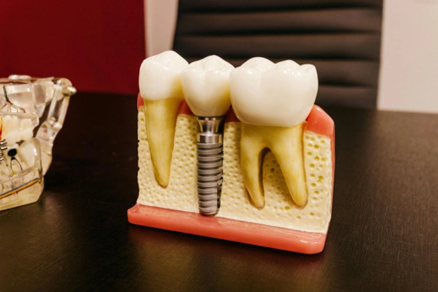 What to Expect During a Single Tooth Implant Procedure in Long Beach