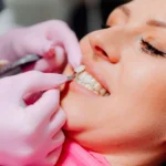 What to Know Before Getting Dental Veneers in Las Vegas